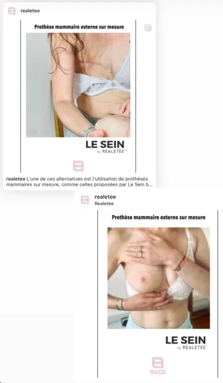 Prothèse mammaire externe réaliste sur mesure via REALETEE après cancer du sein
